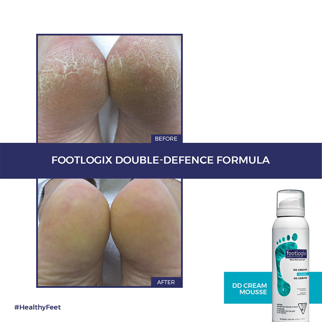 Footlogix Dd Cream Mousse (125ml)